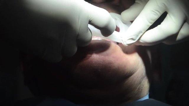 dentista effettua operazione di implantologia su di un paziente