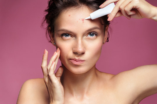 Scowling girl pointing at her acne and applying treatment cream. Photo of young girl with problem skin on pink background. Skin care concept