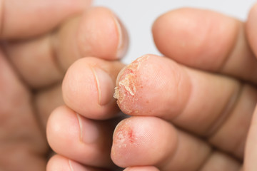 Close up of skin allergy problem, blisters filled with fluid and itchy.Advanced stage of dyshidrosis on fingers,cracked and peeling skin compare with normal fingers.
