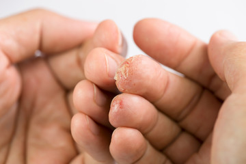 Skin allergy problem, blisters filled with fluid and itchy.Advanced stage of dyshidrosis on...