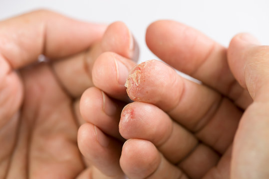 Skin allergy problem, blisters filled with fluid and itchy.Advanced stage of dyshidrosis on fingers,cracked and peeling skin compare with normal fingers.