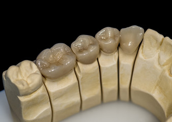 Ceramic zirconium in final version. Staining and glazing. Precision design and high quality materials. Digital technology.