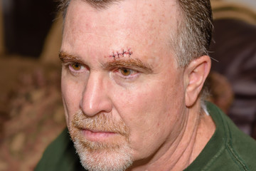 Obraz premium Adult male portrait profile with head injury