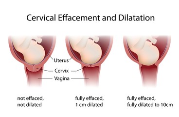 Cervical Effacement and Dilatation