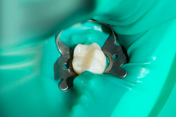 treatment and restoration of rotten carious tooth after root canal filling endocanal pins from fiberglass and photopolymer sealing material