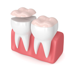 3d render of teeth with dental onlay
