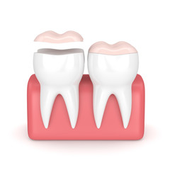 3d render of teeth with dental onlay