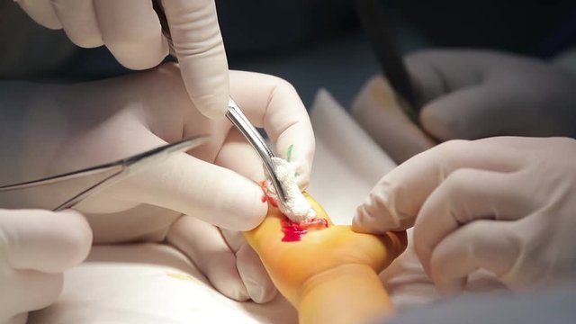 Microsurgeon snips the tissues of a fused child's fingers with surgical scissors close-up 

(1080p, 50fps)
