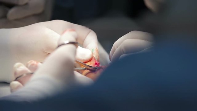 Microsurgeon cuts the tissues between a fused child's fingers close-up (1080p, 50fps)
