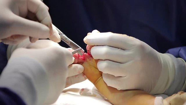 Microsurgeon sews the tissues between separated child's fingers macro (1080p, 50fps)
