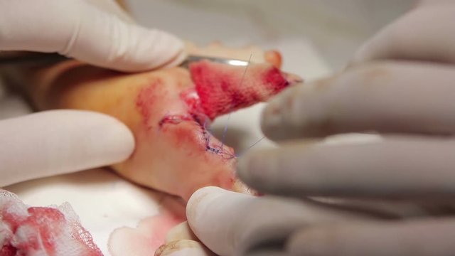 Microsurgeons sutures the finger after separation because of syndactyly fused macro 

(1080p, 50fps)