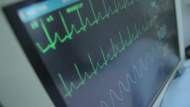 ECG monitor display with a data during the surgery (1080p, 50fps)
