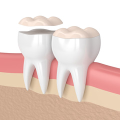 3d render of teeth with dental onlay