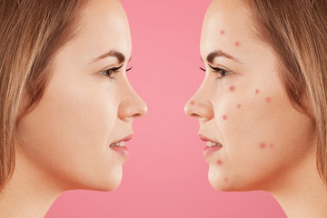 Sideways shot of two female`s faces: one with healthy pure skin and other with many pimples, has acne, constrast bewtween healthy and unhealthy skin. Skin care, dermatology and cosmetics concept