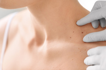 Dermatologist examining birthmark of patient, closeup. Cancer concept