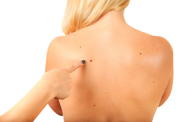 Female hand shows big birthmark on the female back