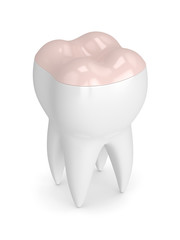 3d render of tooth with dental onlay filling