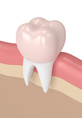 3d render of tooth with dental crown