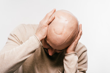Naklejka premium Bald man psychological stress struggling for life arter brain tumor. Heartbreaking male emotions after cancer neurosurgery operation. Oncology survivor patient. Chemotherapy and irradiation head marks