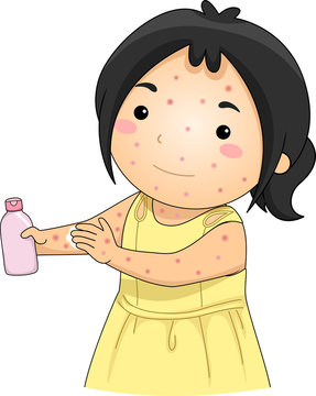 recommend clip art: Kid Girl Chicken Pox Unscented Lotion Illustration