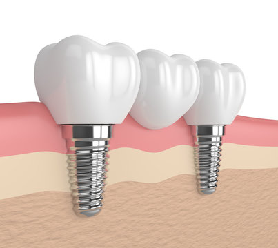 3d render of implants supported dental bridge