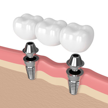 3d render of implants supported dental bridge