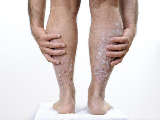 Adult Caucasian man suffering from psoriasis in the legs