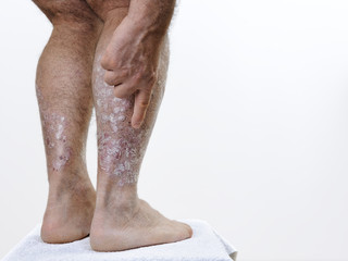Adult Caucasian man suffering from psoriasis in the legs