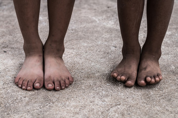 The foot of a poor child close up.