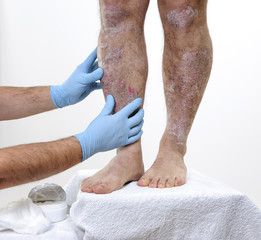 The dermatologist visits an adult man with psoriasis in the legs