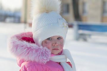 beautiful baby girl with frostbitten face or with allergic rash on cheeks playing in the snow outdoors in winter