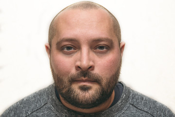 Portrait of stressed tired sad man with bags under eyes looks at camera, insomnia and depression...