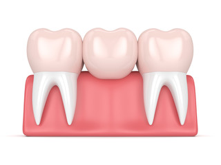 3d render of dental bridge with dental crowns