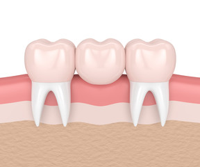 3d render of dental bridge with dental crowns