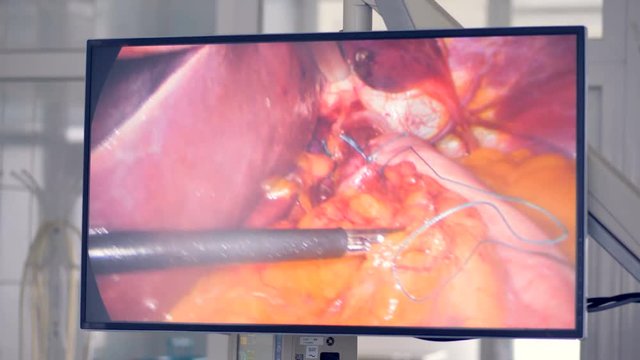 Screen shows how surgeon uses medical robot at modern clinic. Innovative medicine concept.