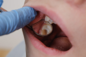 Fototapeta premium Medical examination of teeth using a mirror by a dentist. Caries, tooth damage.
