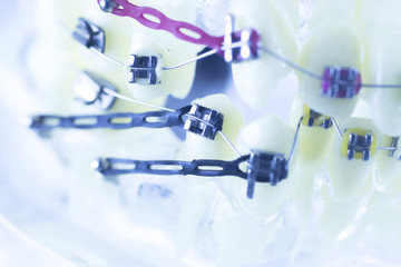 Dental teeth brackets aligners