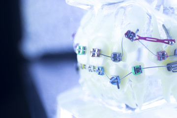 Dental teeth brackets aligners