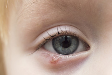 Fototapeta premium Illness person eye with sty and pus looking into the camera