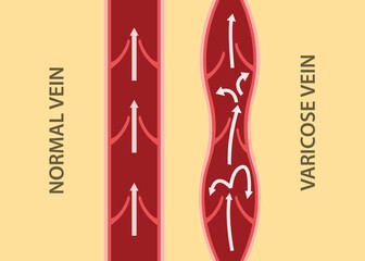 comparison compare between normal vein and varicose vein in vertical alignment