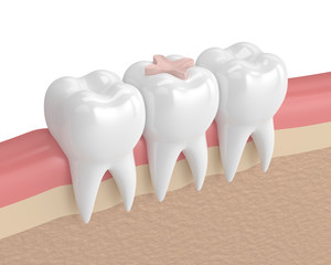 3d render of teeth with dental inlay filling