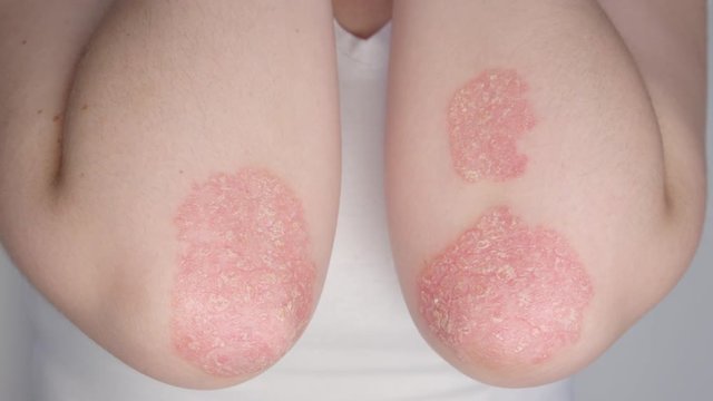 CLOSE UP Painful patches of irritated skin cracking on unknown psoriasis patient's elbows. Pesky and painful rashes with flaking skin growing larger on Caucasian person's arms. Unpleasant skin disease