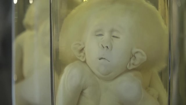 Anatomical preserved human specimens, ugliness, anomalies. Human parts of the body preserved in formalin for scientific study by scientists. Exhibition items in autopsy room.