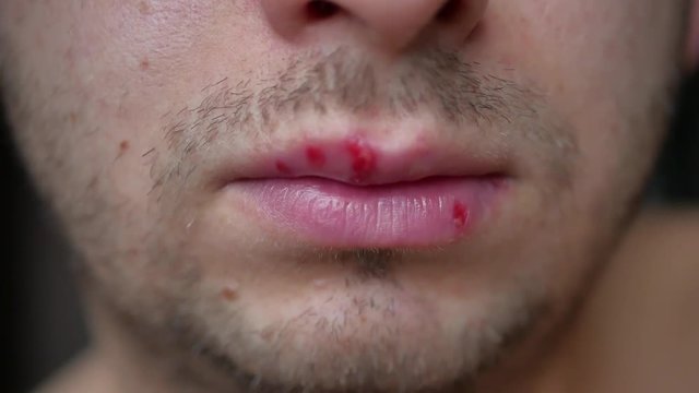 Detail of Herpes on lip of man