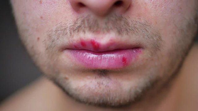Detail of Herpes on lip of man