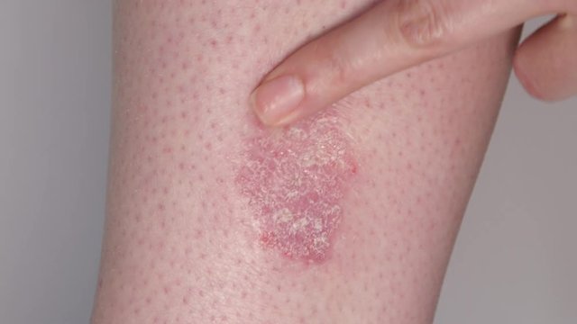 CLOSE UP Unrecognizable woman applying anti-inflammatory corticosteroid medicine for psoriasis on red & dry skin patch. Moisturizing ointment applied to skin eczema. Symptomatic therapy in dermatology