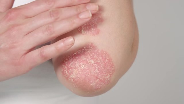 CLOSE UP: Unrecognizable Woman Applying Corticosteroid Cream On Red Scaly Patches On Elbows. Young Patient Affected By Skin Disease Using Medications. Treatment For Hereditary Dermatological Illness