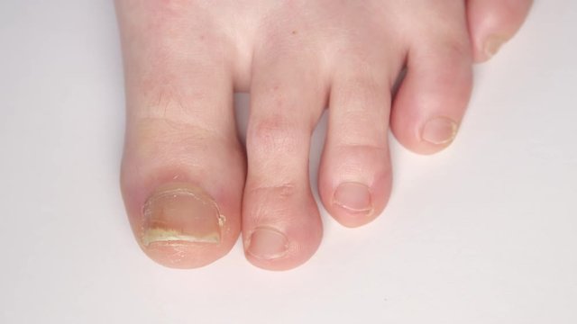 CLOSE UP: Detail of human foot & thickening psoriatic nails separating from nailbed. Thick yellow nails affected by fungus infection. Deformation, detachment, pitting. Psoriasis symptoms, dermatology