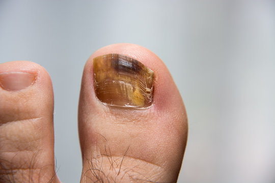 close-up photo, shows nail infection and deformation