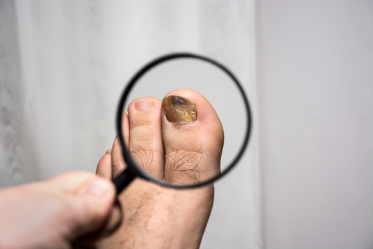 under the magnifying glass, observing changes on a sick nail